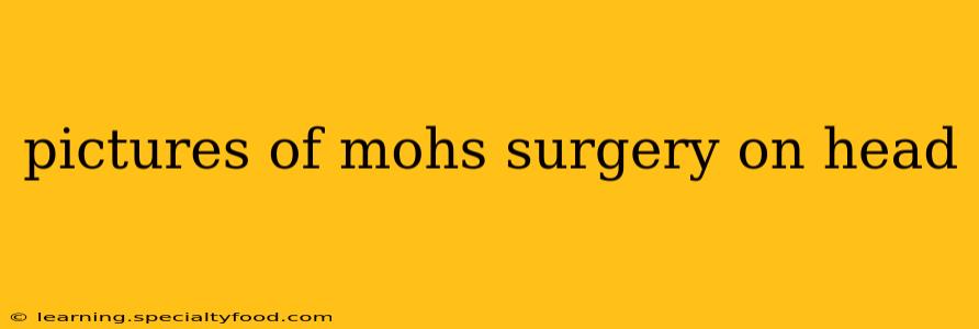 pictures of mohs surgery on head
