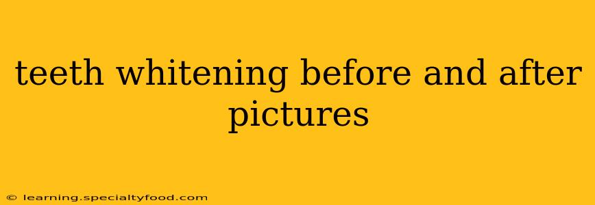 teeth whitening before and after pictures