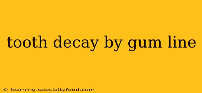 tooth decay by gum line