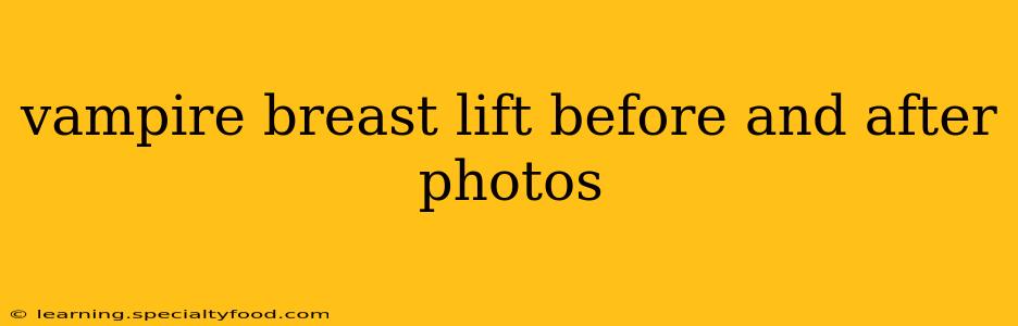 vampire breast lift before and after photos