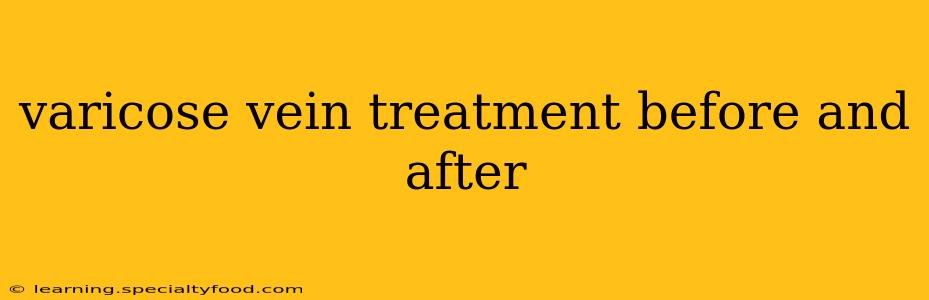 varicose vein treatment before and after